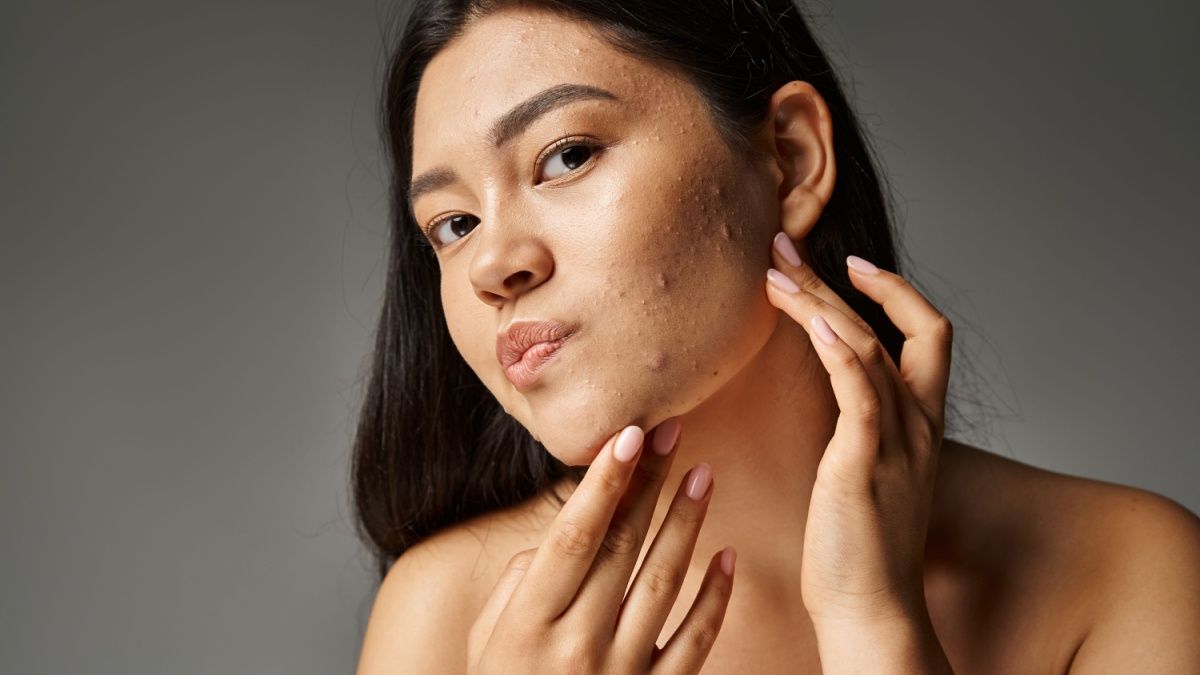 nell'immagine si vede una modella che per l acne utilizza l'olio viso beauty caress di vilo cosmetics